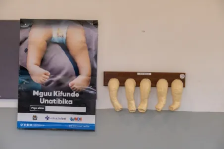 Modelle für die Behandlung nach Ponseti des Projekt Feuerkinder